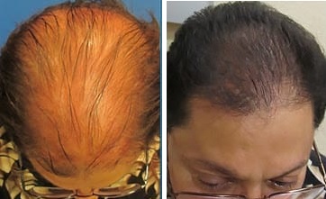 Stem Cell Hair Restoration Sandy, UT | PRP Hair Treatment