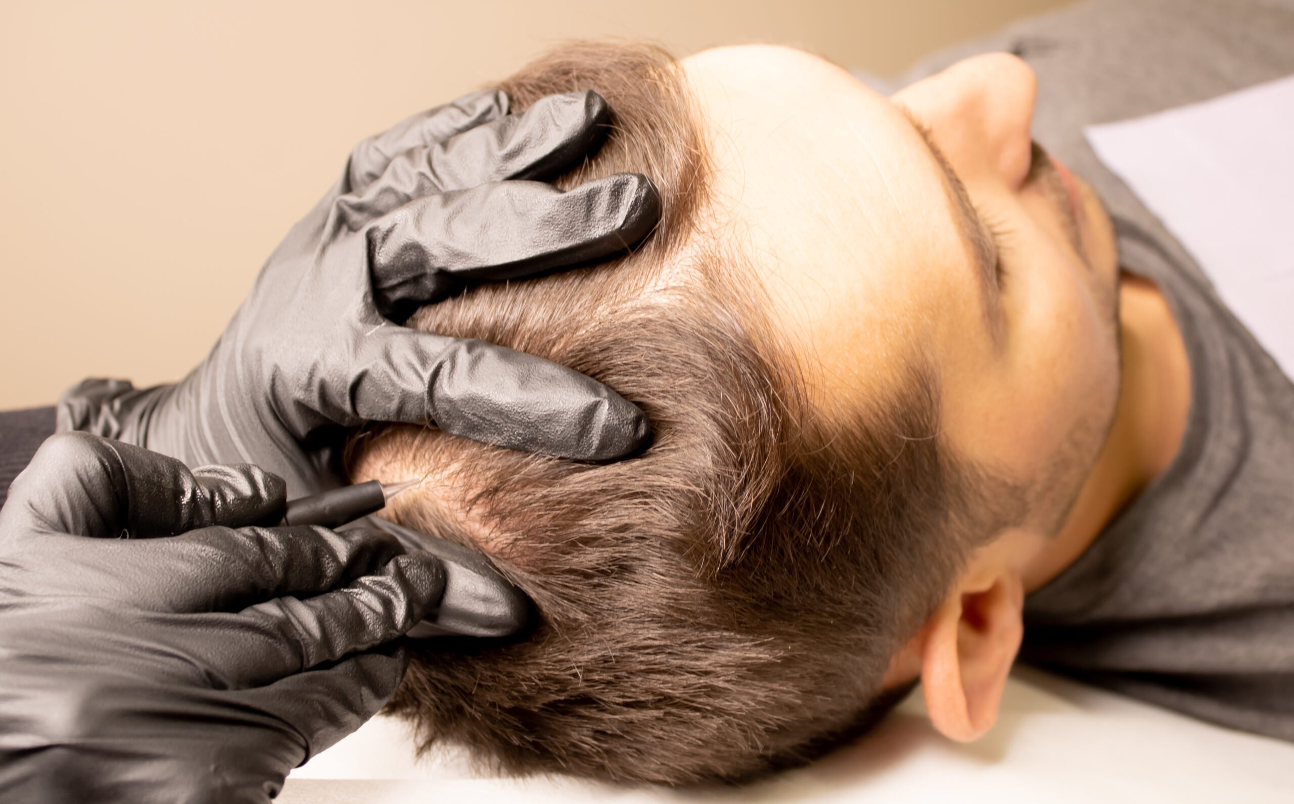 Advantages of Hiring the Best Stem Cell Hair Restoration Expert