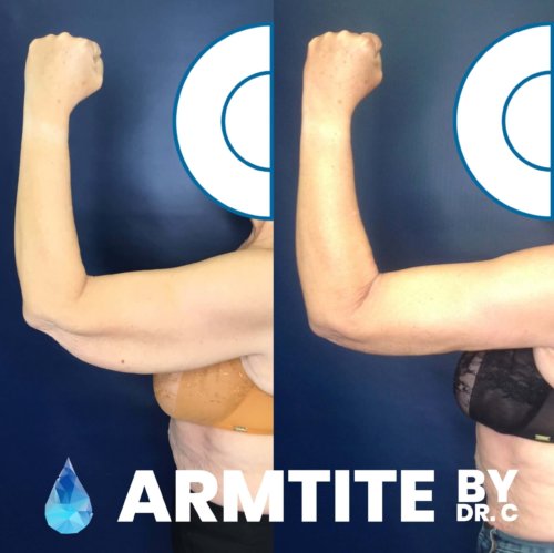 Before & After ArmTite