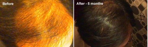 Stem Cell Hair Restoration Sandy, UT | PRP Hair Treatment