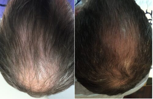 Stem Cell Hair Restoration Sandy, UT | PRP Hair Treatment