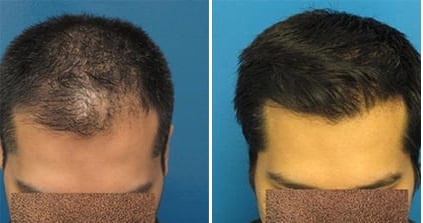 Stem Cell Hair Restoration Sandy, UT | PRP Hair Treatment