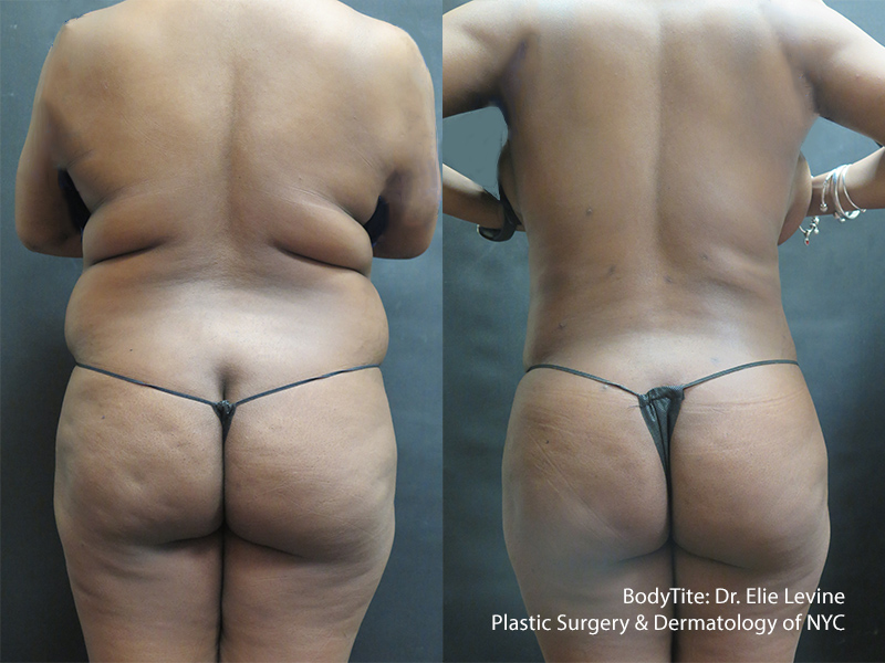 Before And After BodyTite | Fat Removal & Skin Tightening Sandy | Utah Stem Cells