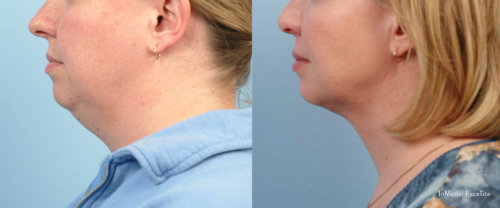 Before and After FaceTite | Non-Surgical Facelift Sandy UT | Utah Stem Cells