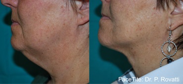 Before and After FaceTite | Non-Surgical Facelift Sandy UT | Utah Stem Cells