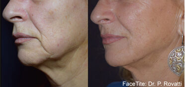 Before and After FaceTite | Non-Surgical Facelift Sandy UT | Utah Stem Cells