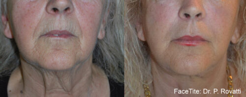 Before and After FaceTite | Non-Surgical Facelift Sandy UT | Utah Stem Cells