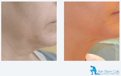 Before & After Forma Face & Body Treatment Sandy UT | Utah Stem Cells