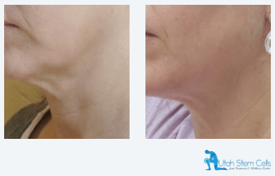 Before & After Forma Face & Body Treatment Sandy UT | Utah Stem Cells