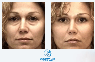 Vampire® Facelift Before & After | Face Rejuvenation Sandy, UT | Utah Stem Cells