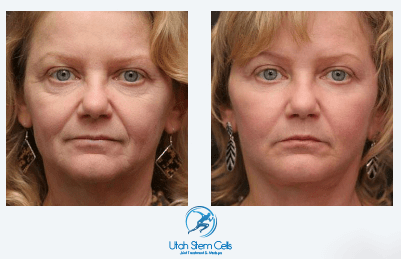 Vampire® Facelift Before & After | Face Rejuvenation
