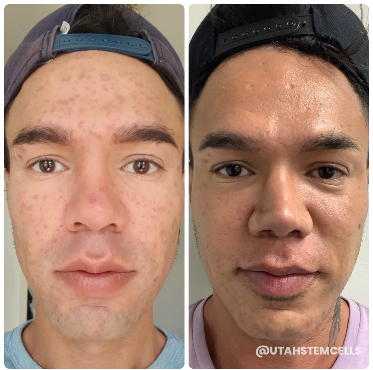 Acne Resurfacing Before & After Treatment Sandy UT | Utah Stem Cells