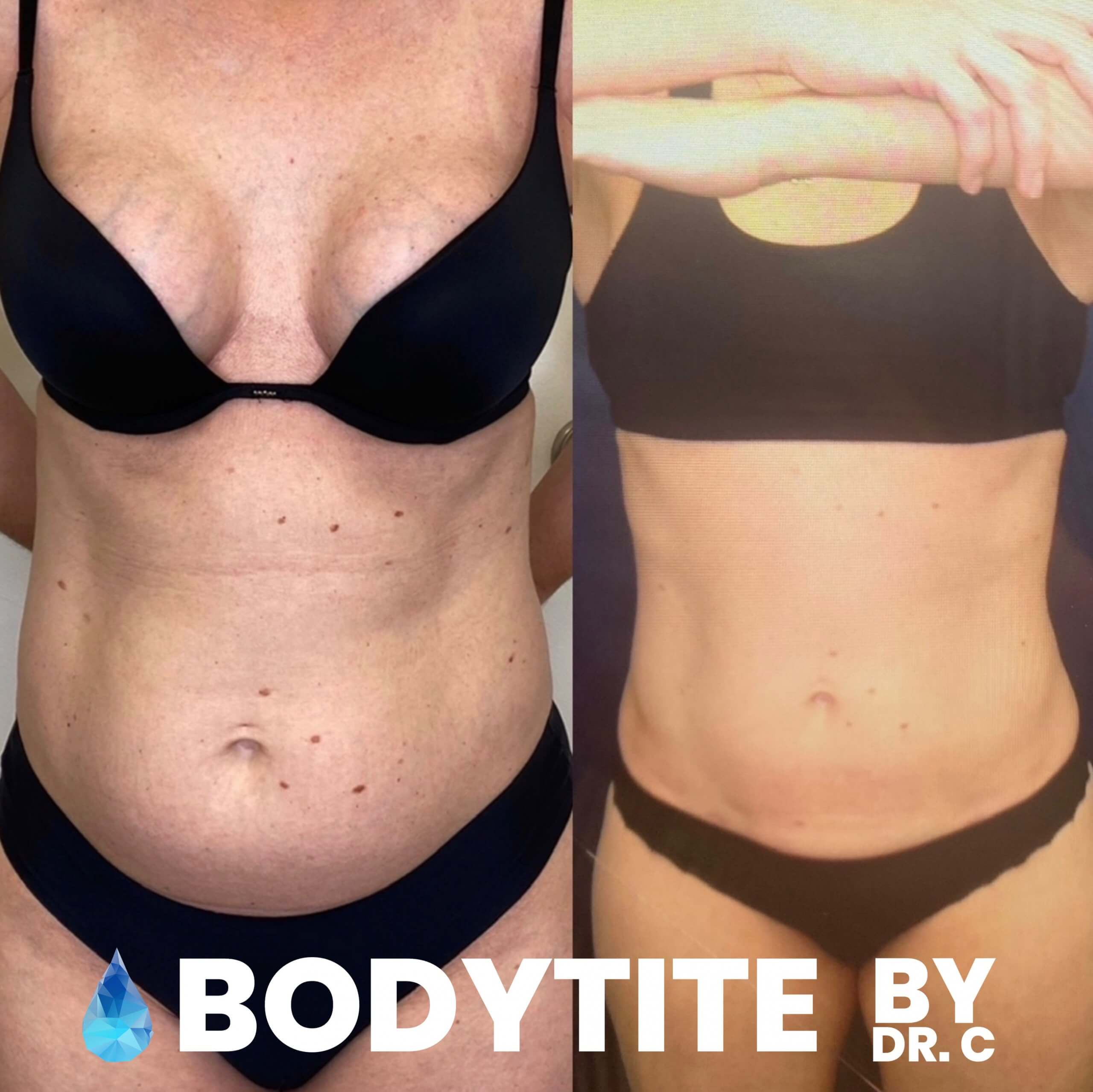 Before & After BodyTite