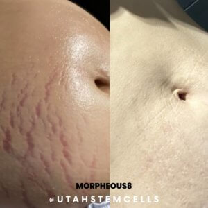 Before And After morpheous8 stretch marks