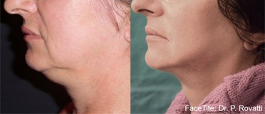 Before and After FaceTite | Non-Surgical Facelift Sandy UT | Utah Stem Cells