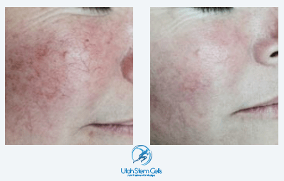 IPL Photofacial Before & After | IPL Laser Skin Treatment Sandy UT | Utah Stem Cells