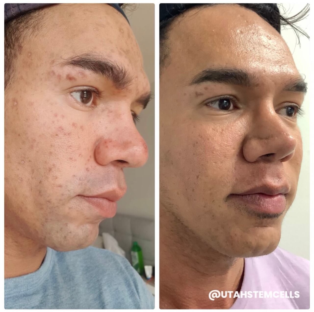 Acne Resurfacing Before & After Treatment Sandy UT | Utah Stem Cells