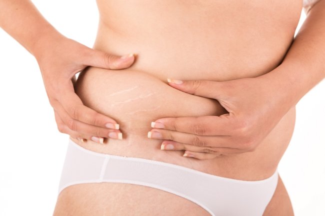 Stretch Marks Resurfacing Sandy UT | Utah Stem Cells