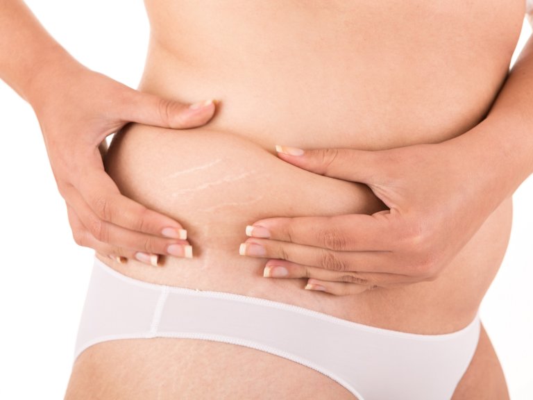 Stretch Marks Resurfacing Sandy UT | Utah Stem Cells