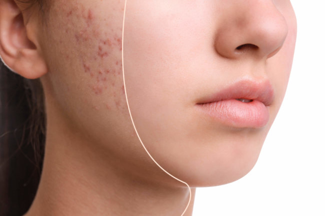 Acne Resurfacing Treatment Sandy UT | Utah Stem Cells