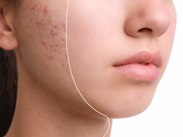 Acne Resurfacing Treatment Sandy UT | Utah Stem Cells