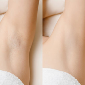 Under Arm Laser Hair Removal