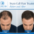 Before and After Stem Cell Hair Treatment: What Nobody Tells You